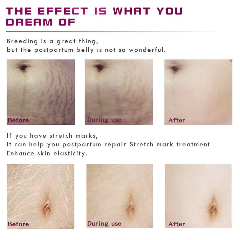 Stretch Mark Remover Essential Oil Care Cream – Bild 2